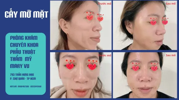 Cấy Mỡ Mặt