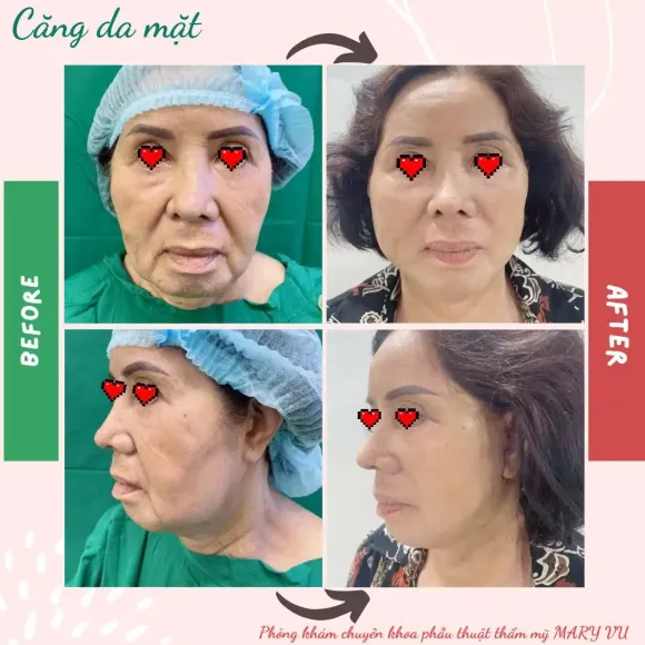 Căng Da Mặt 