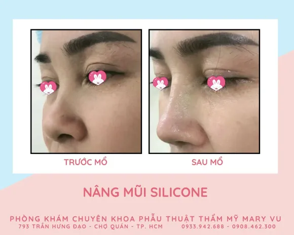 Nâng Mũi