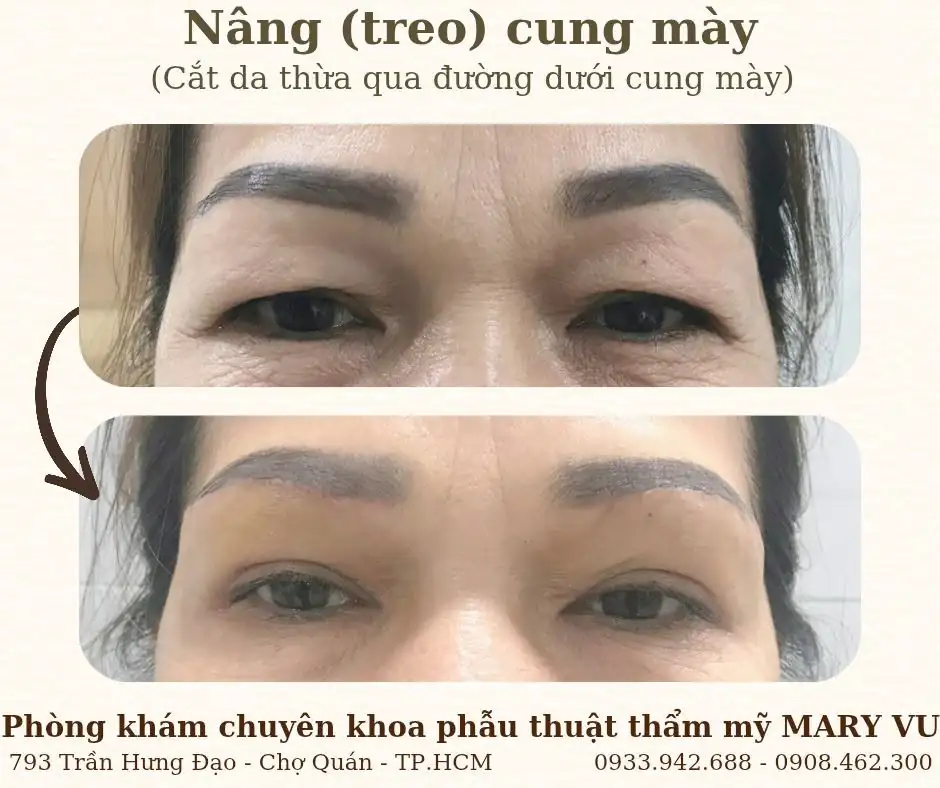 PK Phẫu Thuật Thẩm Mỹ Mary Vu
